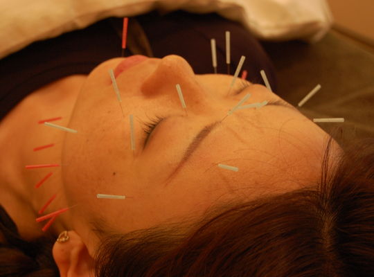 顔に鍼を打っている