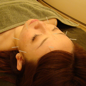 船堀で安く美容鍼を受ける