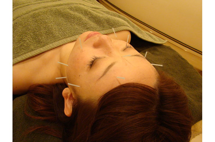 船堀で安く美容鍼を受ける